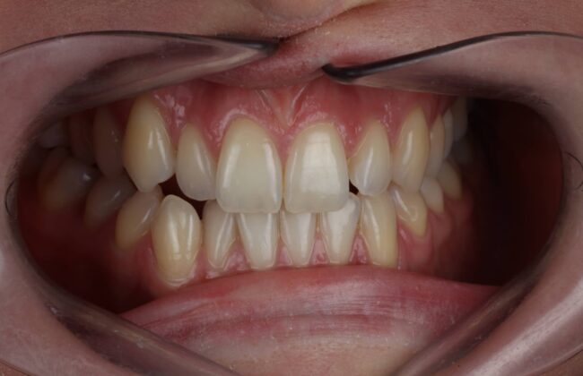 Before (Teeth)