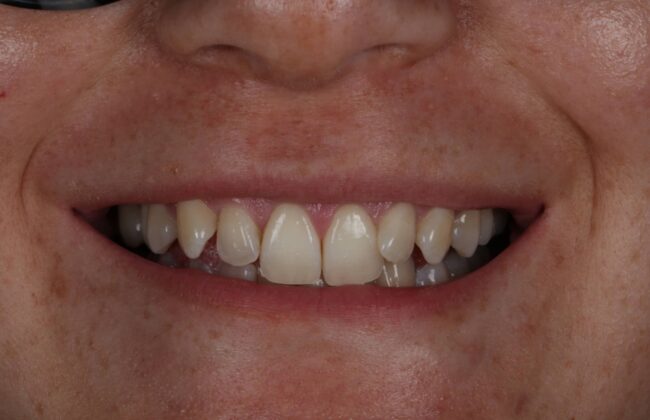Before (Teeth)