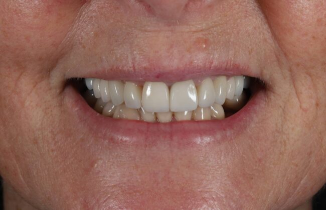 After (Teeth)