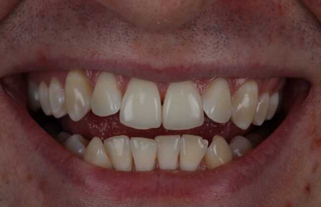 Before (Teeth)