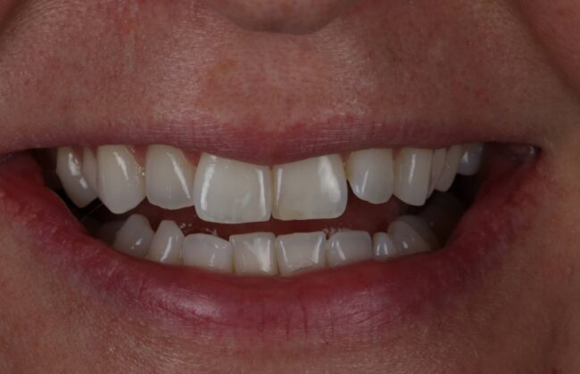 Before (Teeth)