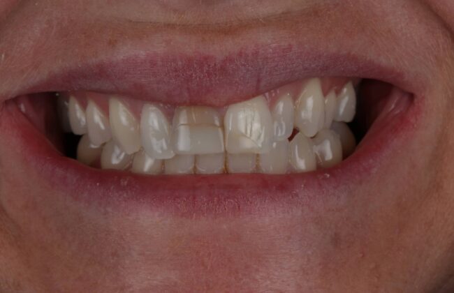 Before (Teeth)