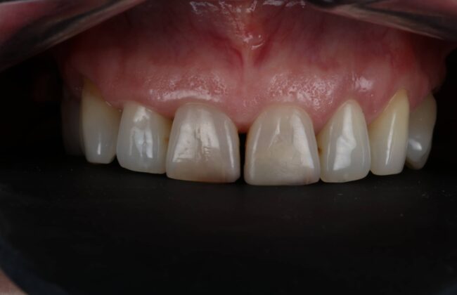 Before (Teeth)