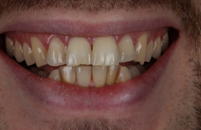 Before (Teeth)