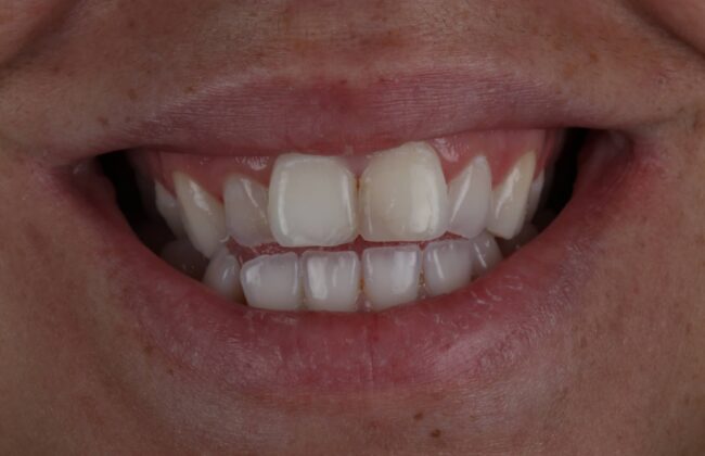Before (Teeth)