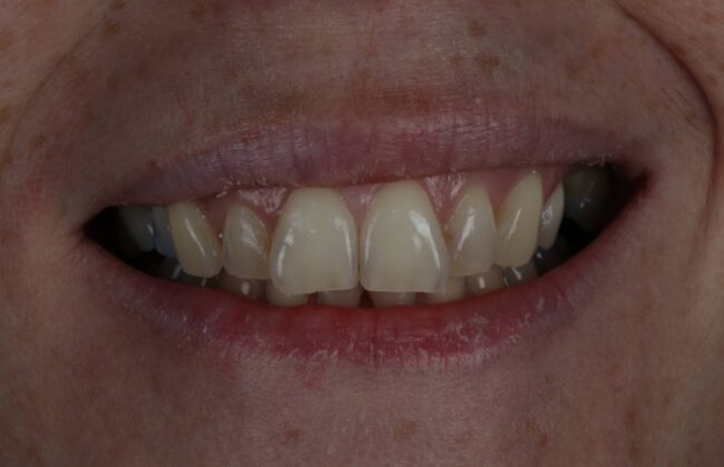 Before (Teeth)