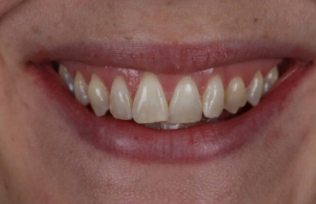 Before (Teeth)