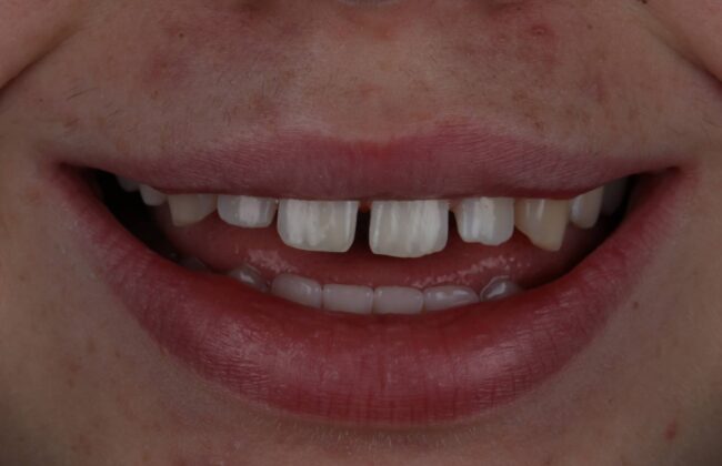 Before (Teeth)