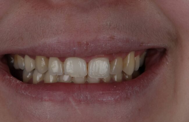 Before (Teeth)