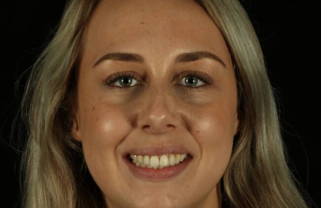 After (Teeth)