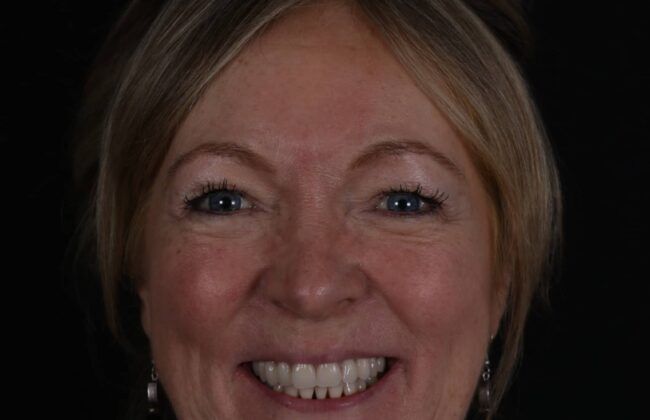 After (Teeth)