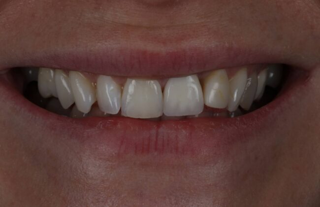 Before (Teeth)
