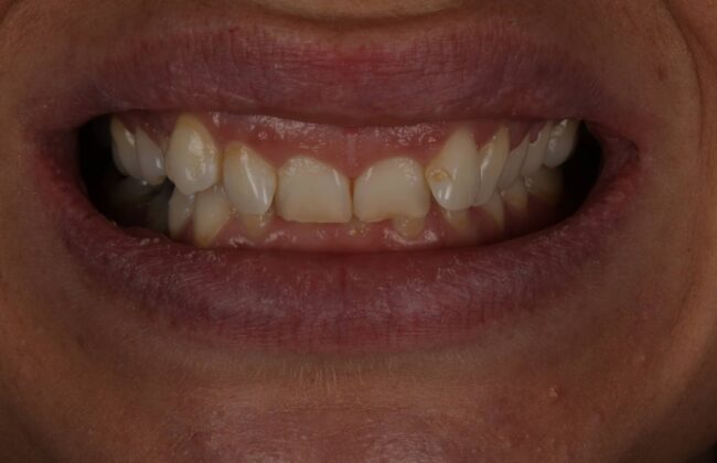 Before (Teeth)