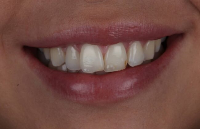Before (Teeth)