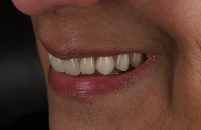 After (Teeth)