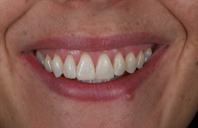 After (Teeth)