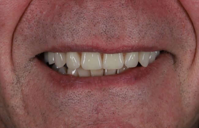 After (Teeth)