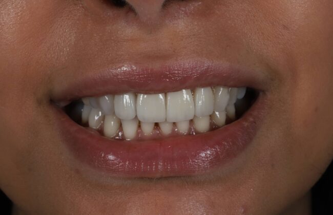 After (Teeth)