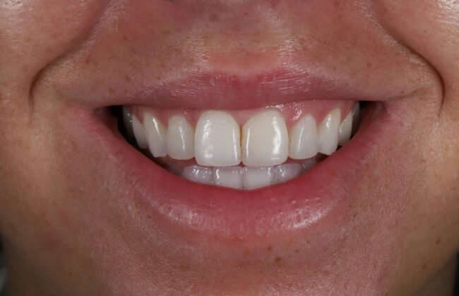 After (Teeth)