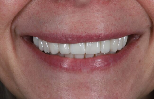 After (Teeth)