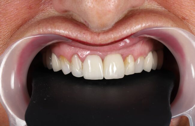 After (Teeth)