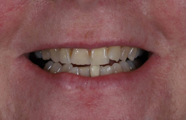 Before (Teeth)