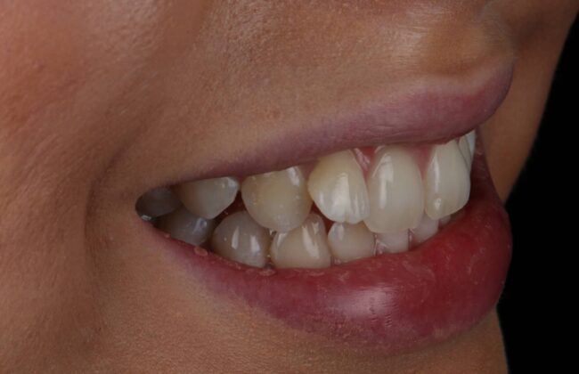 Before (Teeth)