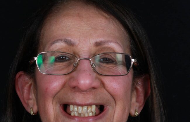 Before (Teeth)