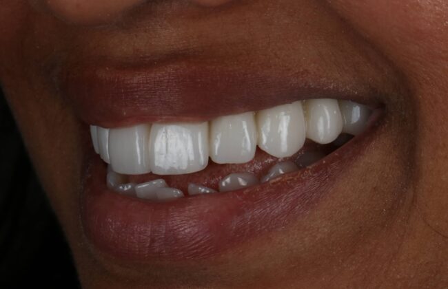 After (Teeth)