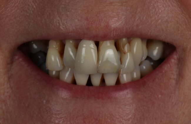 Before (Teeth)