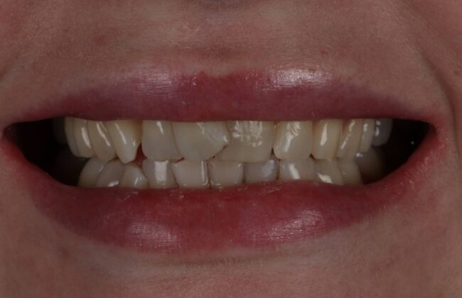 Before (Teeth)