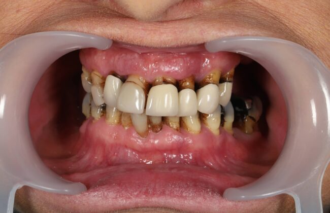Before (Teeth)
