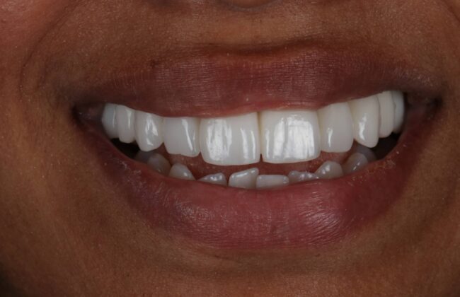 After (Teeth)