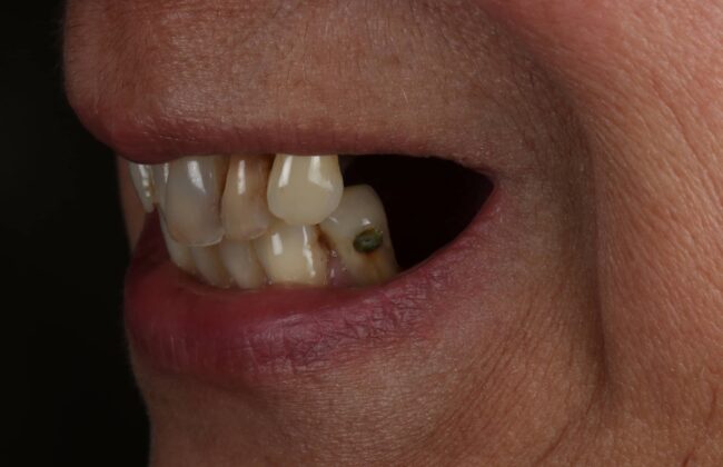 Before (Teeth)