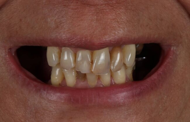 Before (Teeth)