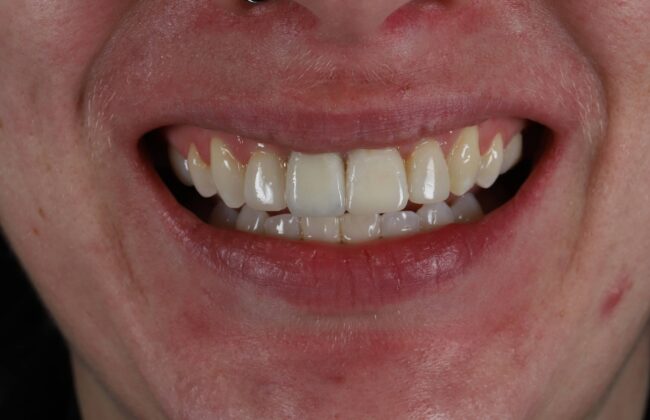 After (Teeth)