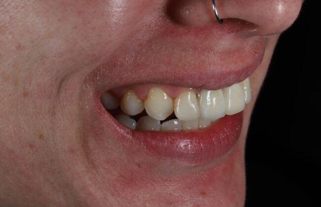 After (Teeth)