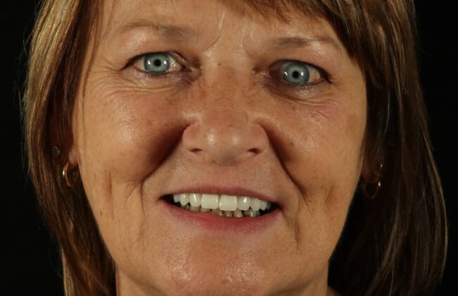 After (Teeth)