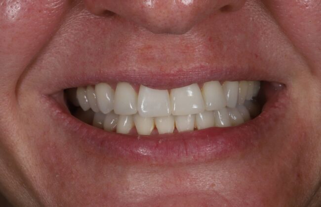 After (Teeth)