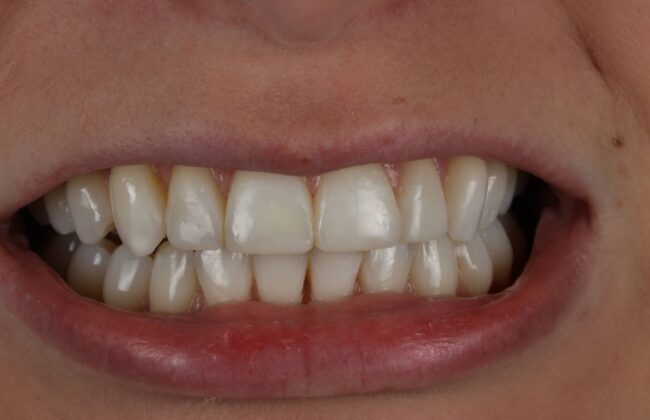 After (Teeth)