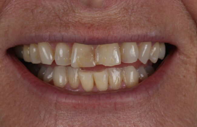 Before (Teeth)