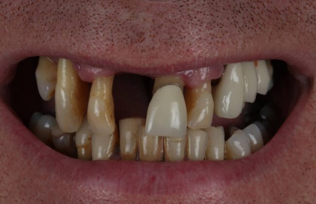 Before (Teeth)