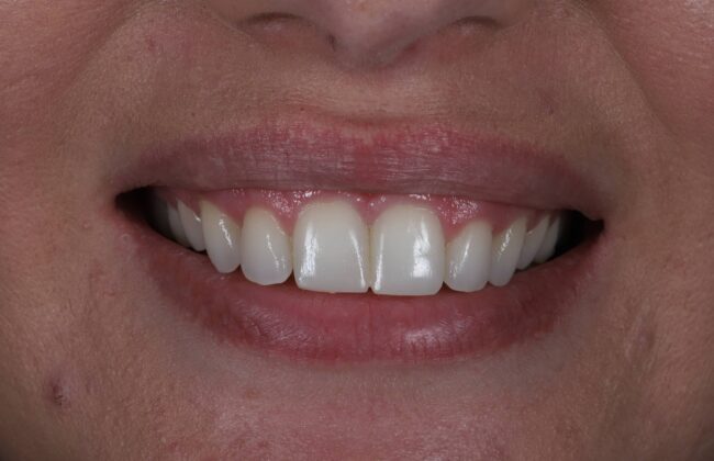 After (Teeth)