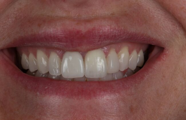 After (Teeth)