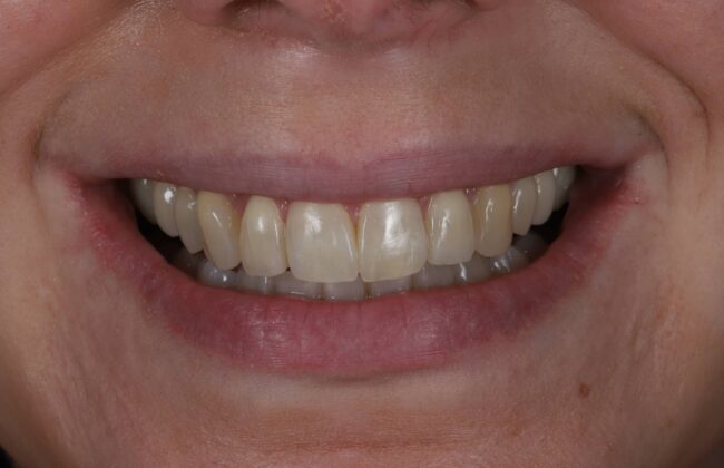 After (Teeth)