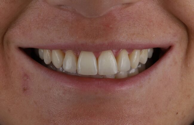 After (Teeth)