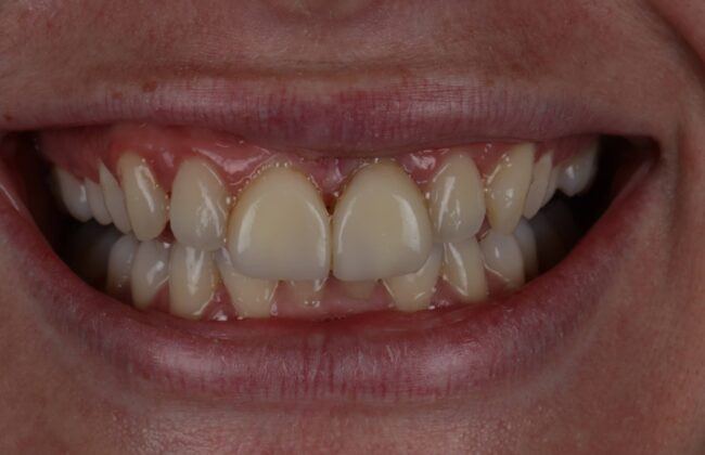 Before (Teeth)