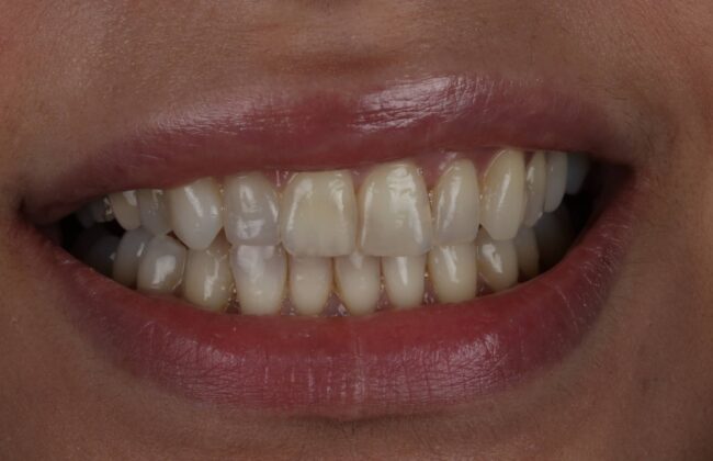 Before (Teeth)