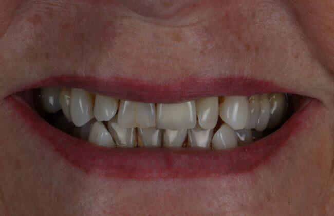 Before (Teeth)