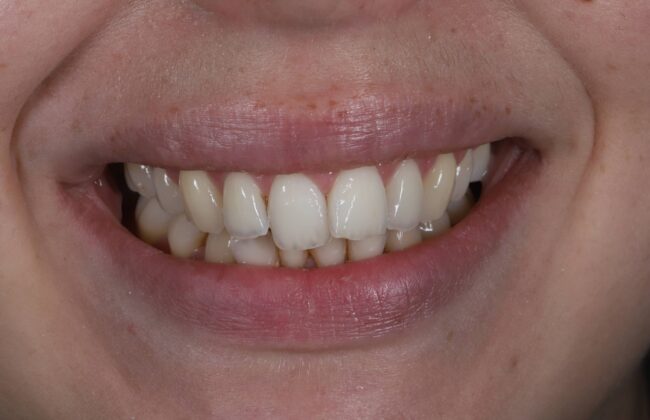 Before (Teeth)